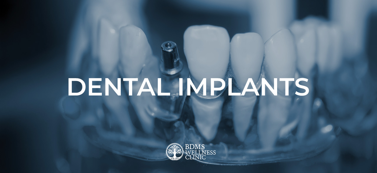 Dental Implants